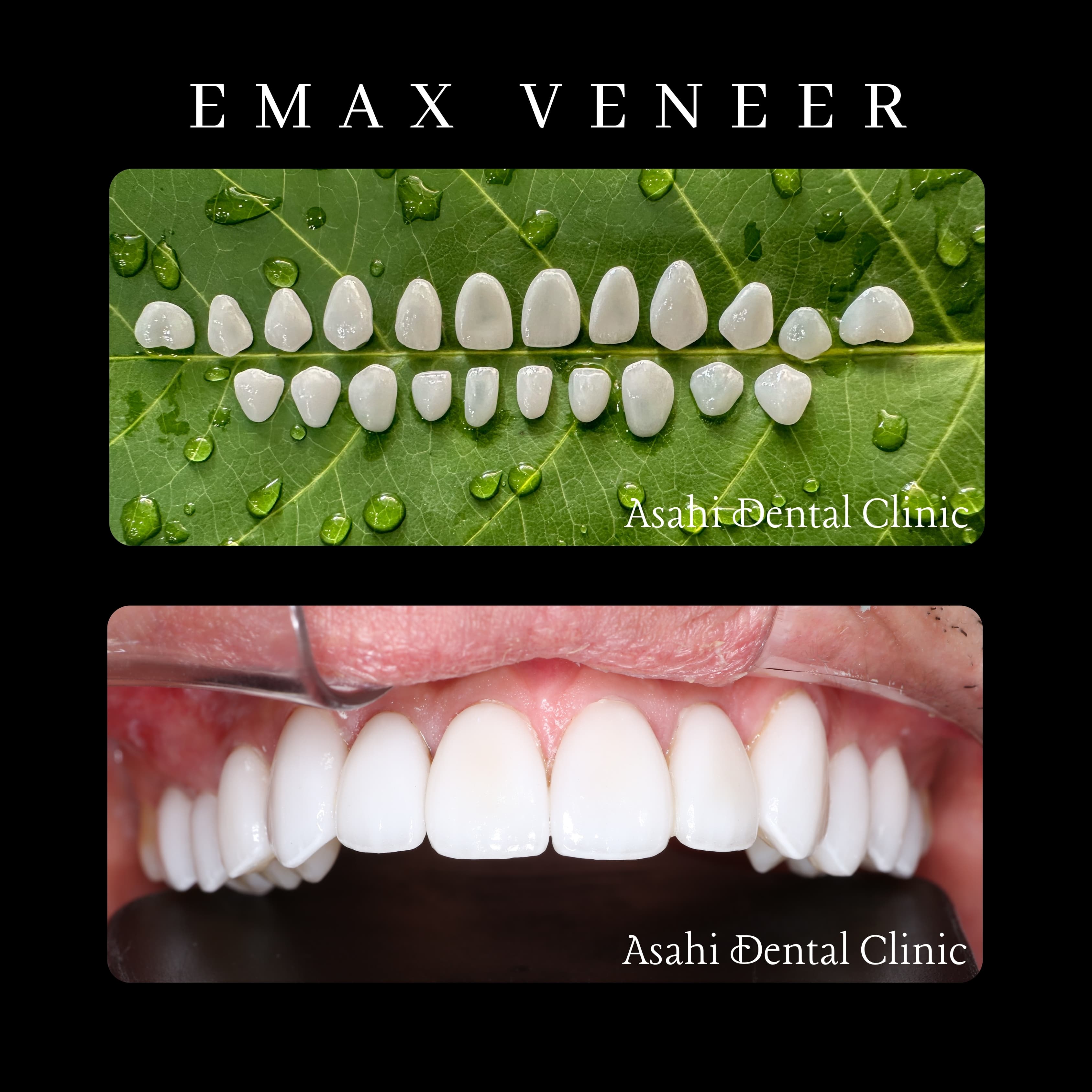 Ceramic veneer ultra-thin layered Emax veneer treatment example at Asahi Dental Specialist Clinic