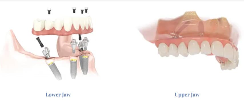 All-on-X full mouth rehabilitation illustration