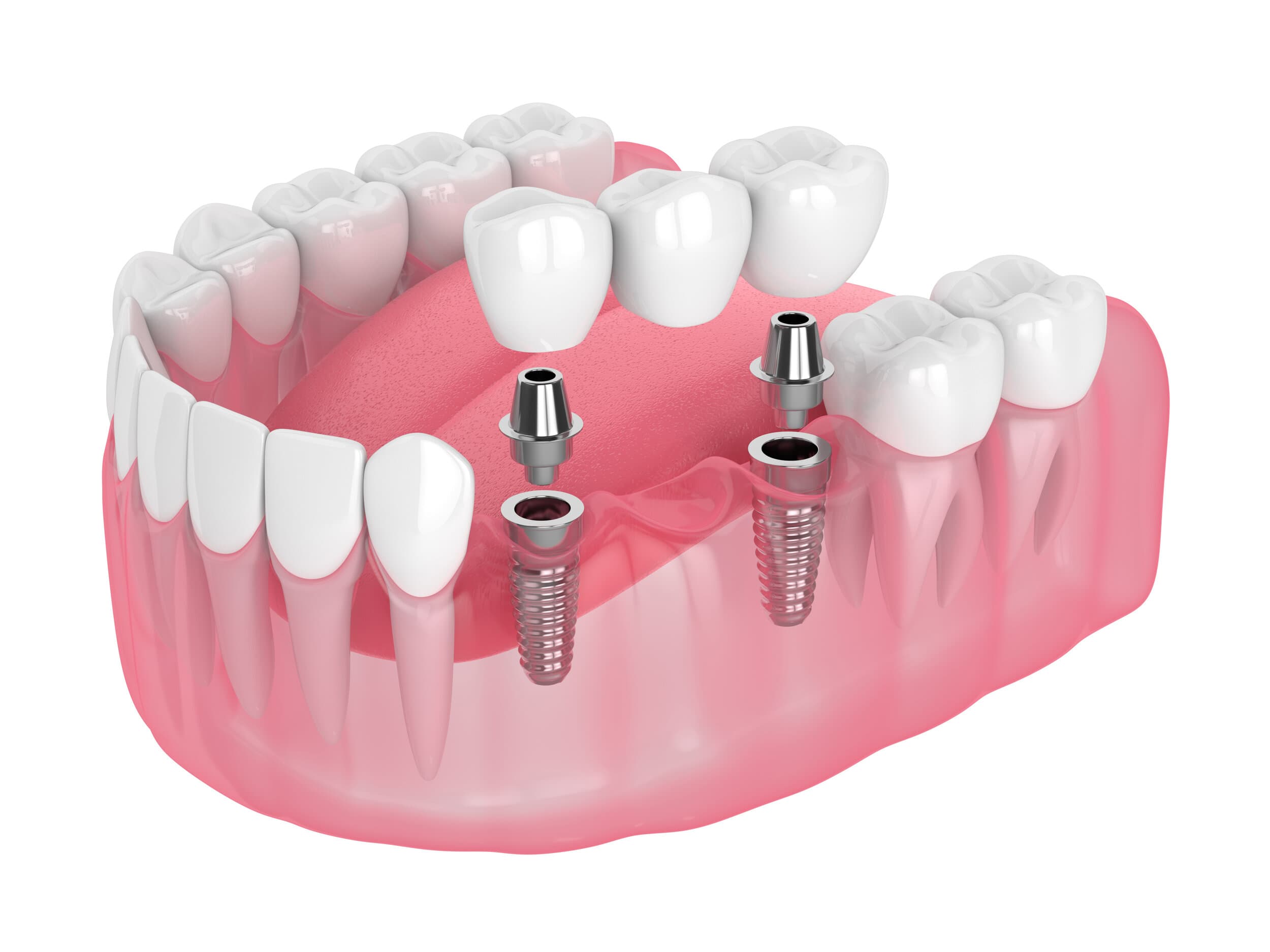 Implant-supported dental bridge illustration