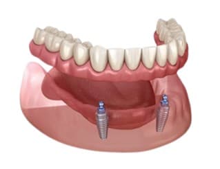 Implant retained overdenture illustration