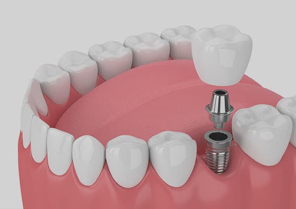 Single dental implant illustration