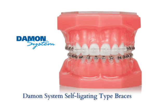 Damon system self-ligating braces treatment