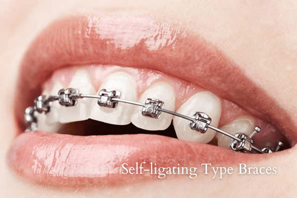 Self-ligating type braces treatment